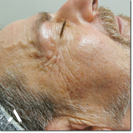 trattamento rughe dopo microneedling trattamento rughe dopo microneedling