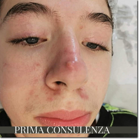 trattamento acne giovanile trattamento acne in adolescenza