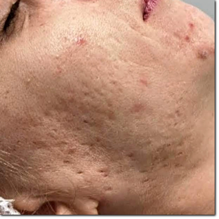 trattamento cicatrici acne