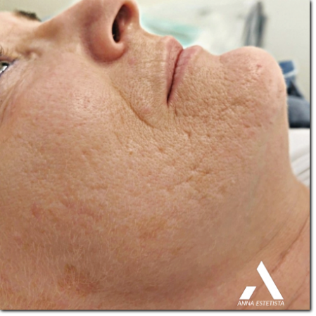 consulenza su cicatrici post acne