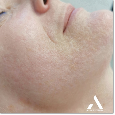 microneedling su cicatrici post acne