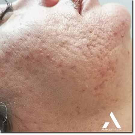 consulenza su cicatrici post acne