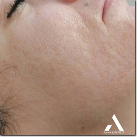 dermostimolazione su cicatrici post acne