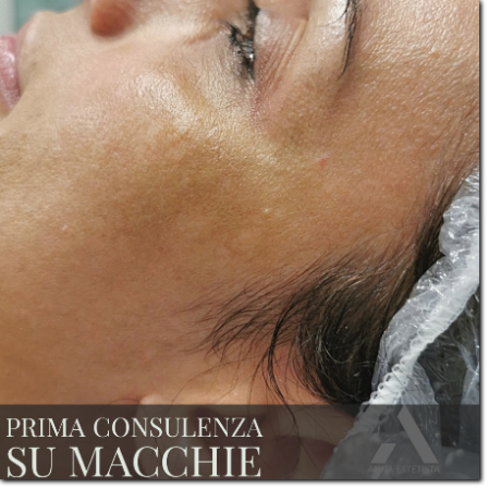 trattamento macchie prima consulenza trattamento macchie prima consulenza