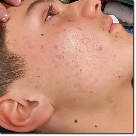 risultato su acne e cicatrici risultato su acne e cicatrici