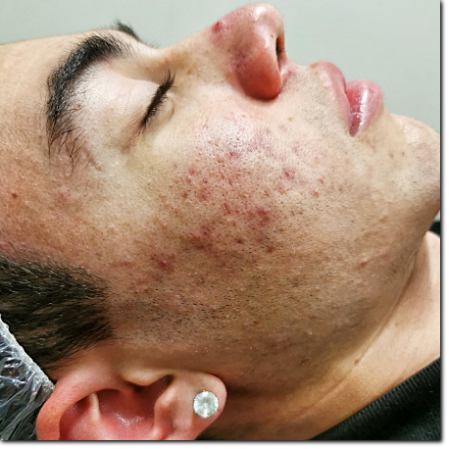 consulenza acne consulenza acne