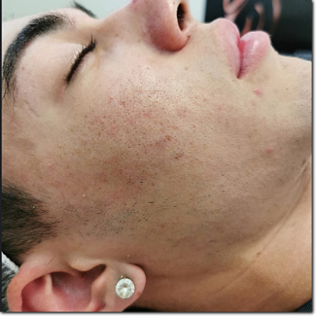 risultato su acne e cicatrici risultato su acne e cicatrici