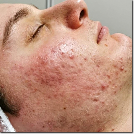 consulenza acne consulenza sull'acne