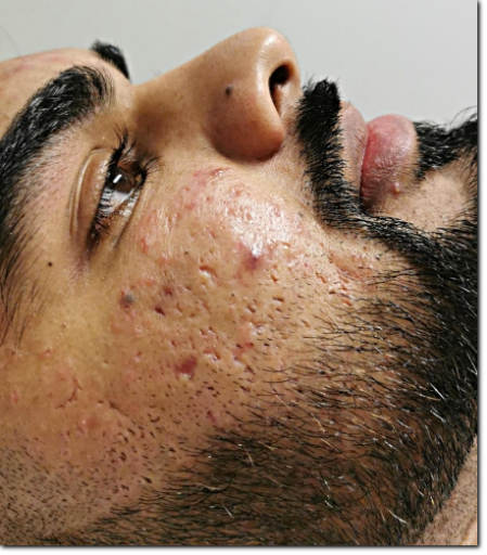 consulenza acne e cicatrici consulenza acne e cicatrici