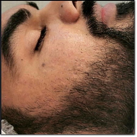 microneedling acne e cicatrici Annaestetista microneedling acne e cicatrici Annaestetista