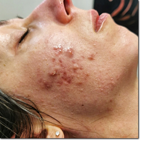 acne e cicatrici risultato su acne e cicatrici