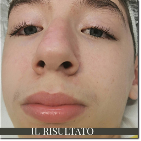 soluzioni per l'acne acne cure