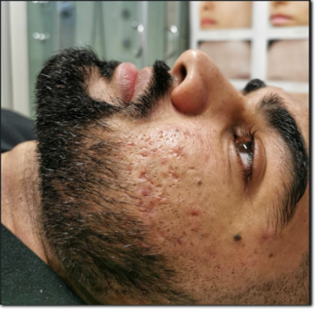 consulenza su acne consulenza su acne