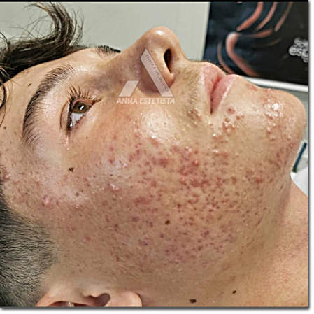 consulenza acne e cicatrici consulenza acne e cicatrici