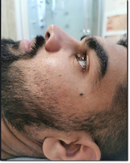 acne trattamenti soluzioni per l'acne