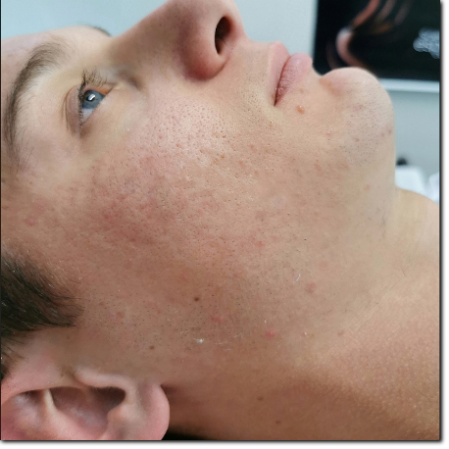 risultato su trattamento acne risultato su trattamento acne