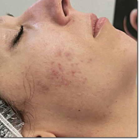 Primo piano del naso di una donna con punti neri o punti neri problemi di  acne comedoni pori dilatati