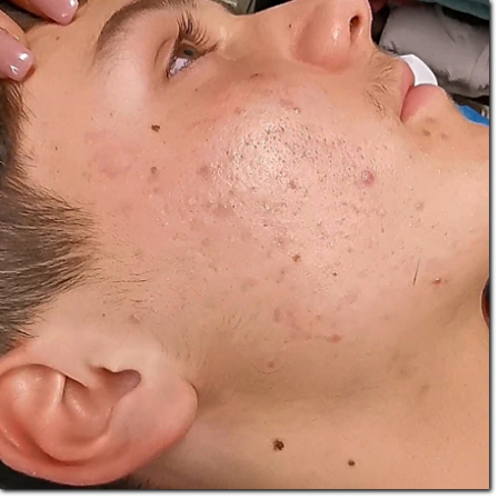 risultato su acne e cicatrici