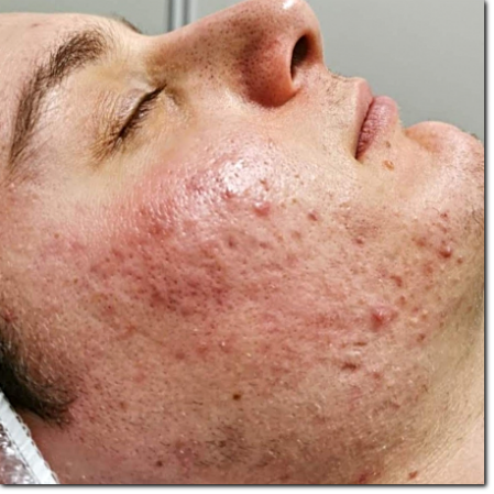 consulenza sull'acne