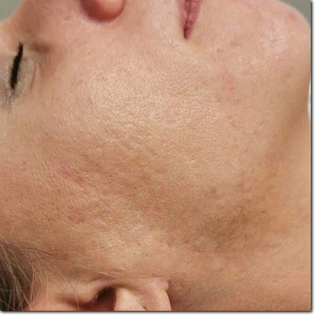 trattamento cicatrici acne dopo dermostimolazione
