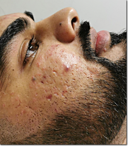 consulenza acne e cicatrici