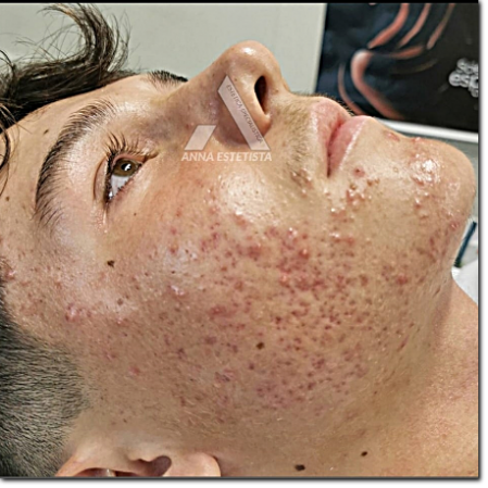  consulenza acne e cicatrici