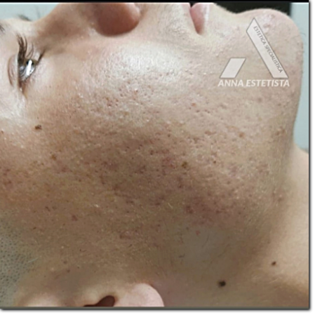 risultato su acne e cicatrici