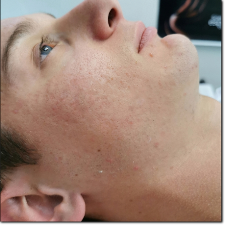 risultato su trattamento acne